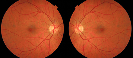 Bilateral Fundus
