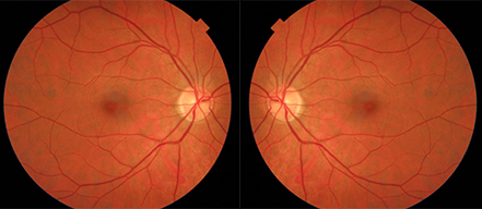 Bilateral Fundus